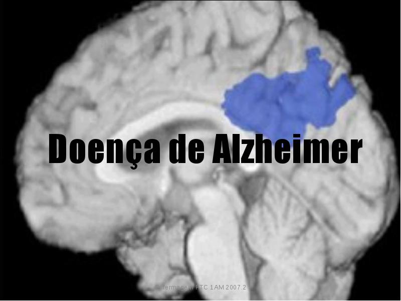 Quando a perda de memória pode ser sinal da Doença de Alzheimer?