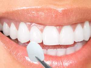Lentes de contato dental: um sorriso perfeito na PIÙ VITA!