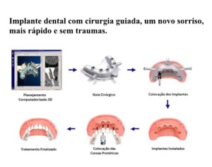 Cirurgia de implantes guiada: sem cortes, mais rápida e com maior conforto