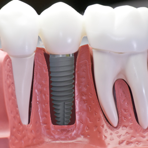 Um novo conceito de implante dental agora na PIÙ VITA