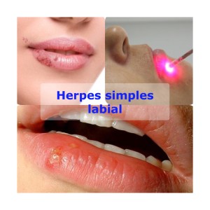Vamos conversar sobre Herpes simples labial