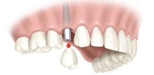Qual a idade ideal para se fazer implantes dentais?